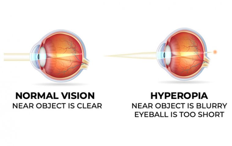 Bilateral Anophthalmia: Understanding This Rare Condition Affecting Newborn Babies Bilateral Anophthalmia: Understanding This Rare Condition Affecting Newborn Babies