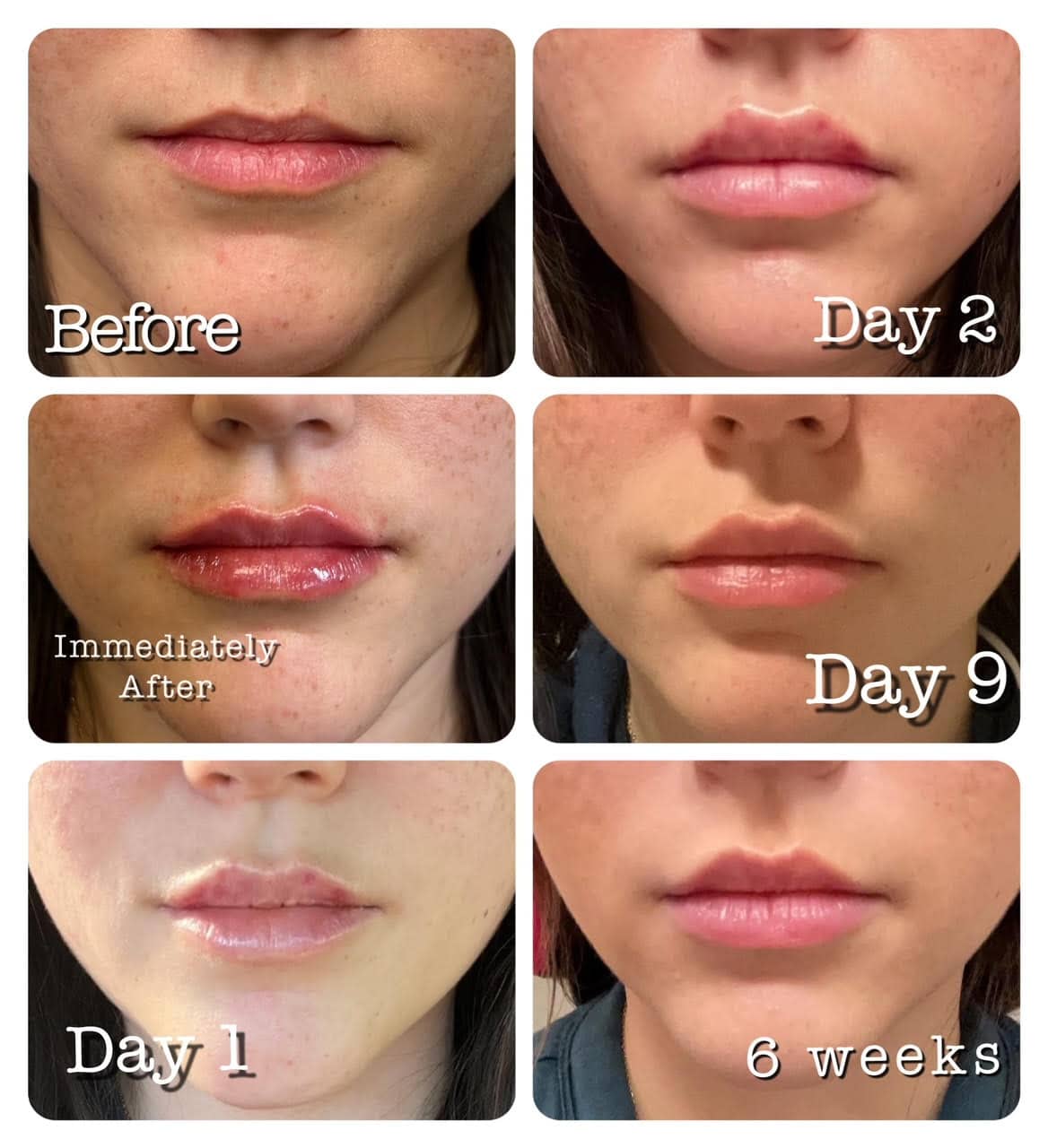 Daisy May Cooper's Weight Loss And Lip Filler Journey: An Honest Account Daisy May Cooper's Weight Loss And Lip Filler Journey: An Honest Account