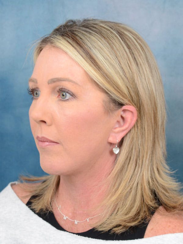 Dramatic Facelift? Star's New Photos Spark Online Debate Dramatic Facelift? Star's New Photos Spark Online Debate