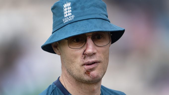 Freddie Flintoff's Face After Top Gear Crash: Full Recovery Update Freddie Flintoff's Face After Top Gear Crash: Full Recovery Update
