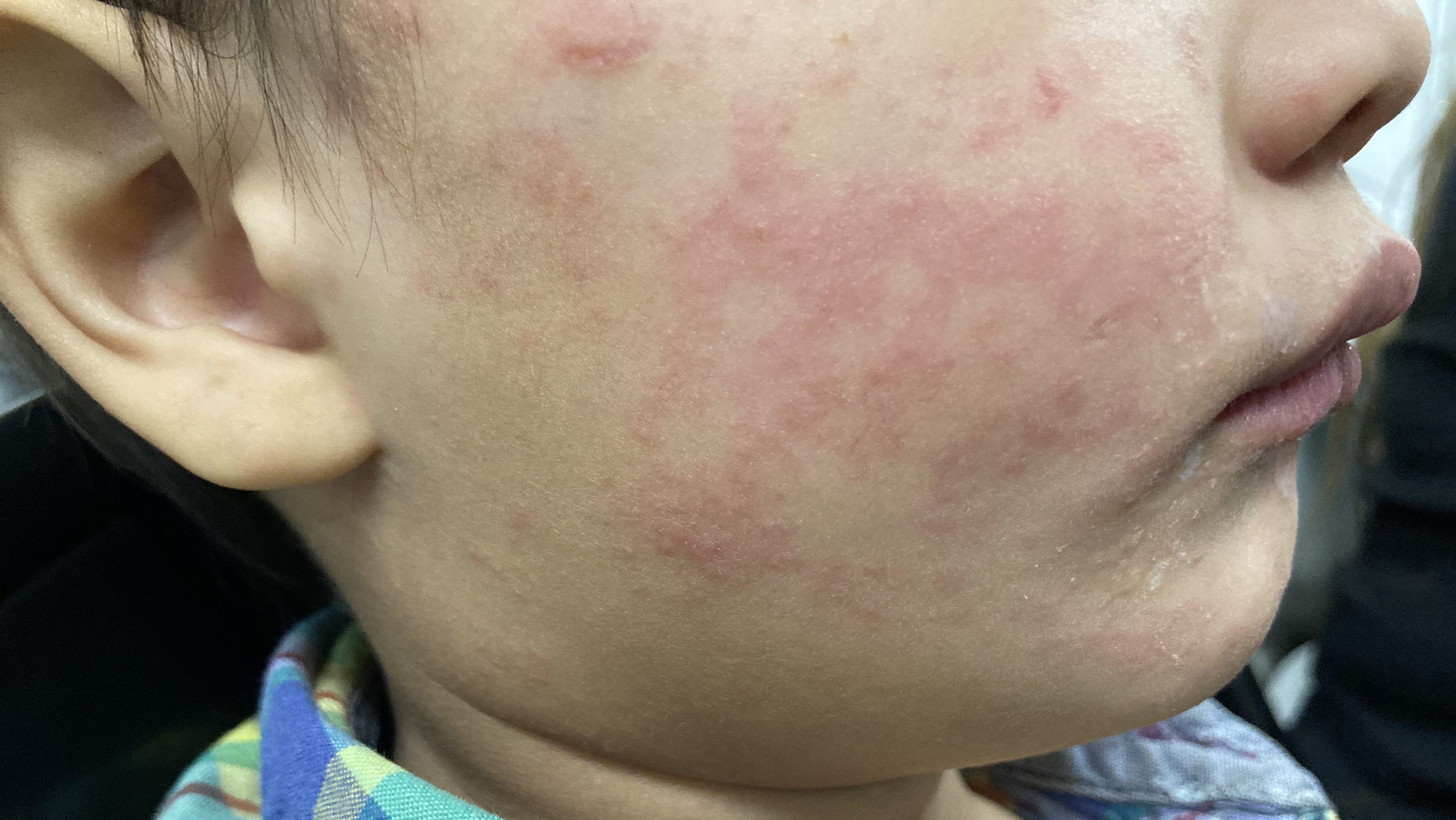 Measles In Texas: New Cases Emerge Outside Initial Outbreak Measles In Texas: New Cases Emerge Outside Initial Outbreak