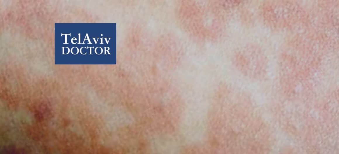 Measles Outbreak Spreads Across Israel Following Texas Case Measles Outbreak Spreads Across Israel Following Texas Case