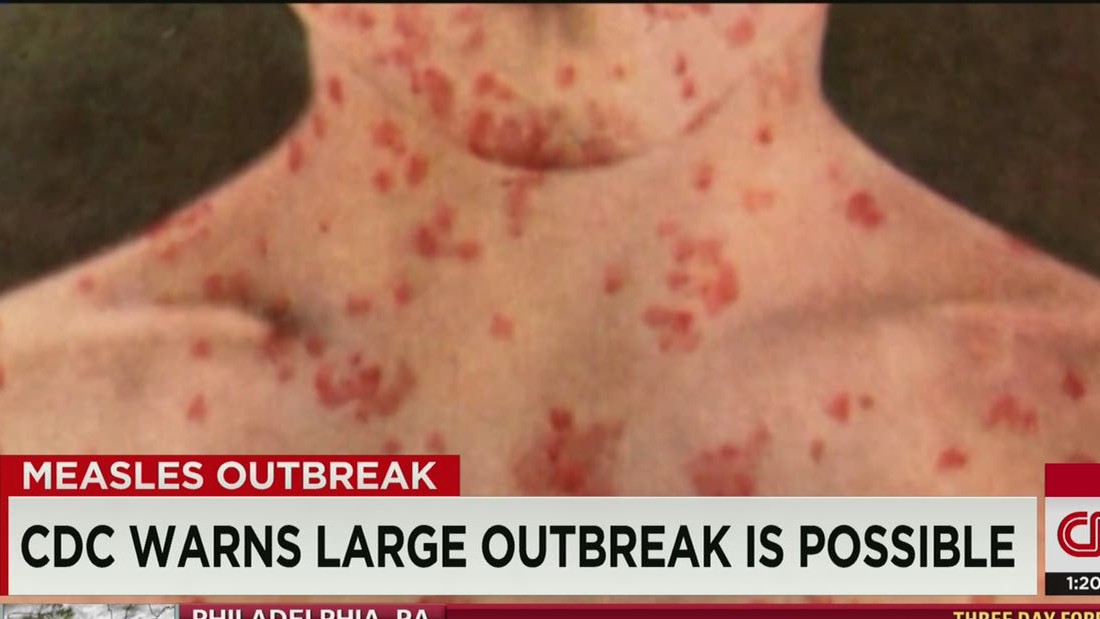More Measles Cases Confirmed In Texas, Unrelated To Known Outbreak More Measles Cases Confirmed In Texas, Unrelated To Known Outbreak