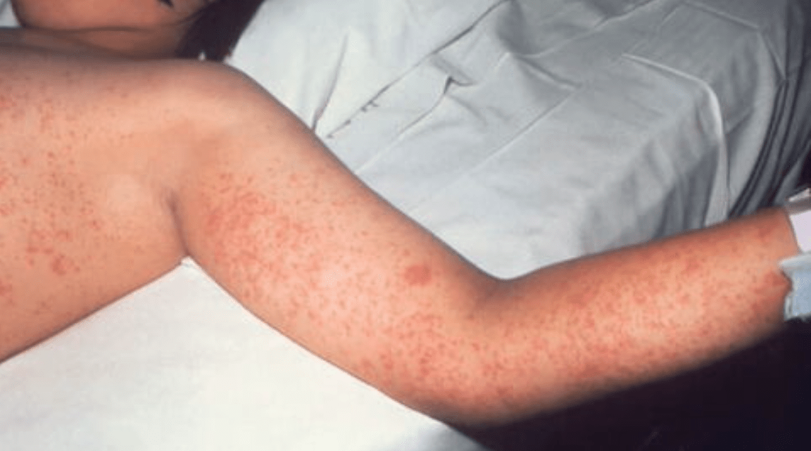 Unconnected Measles Outbreaks In Texas: What You Need To Know Unconnected Measles Outbreaks In Texas: What You Need To Know