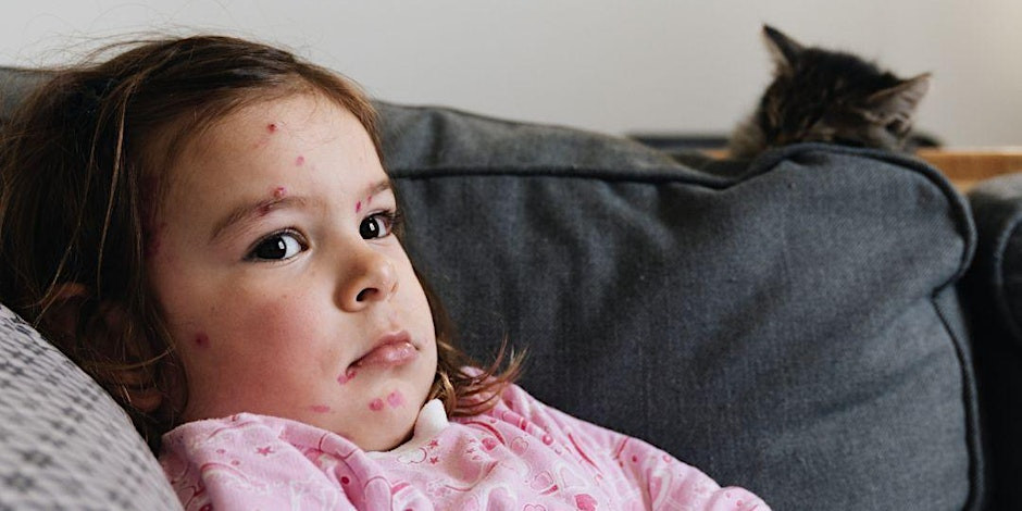 Understanding The Recent Decrease In US Measles Cases Understanding The Recent Decrease In US Measles Cases
