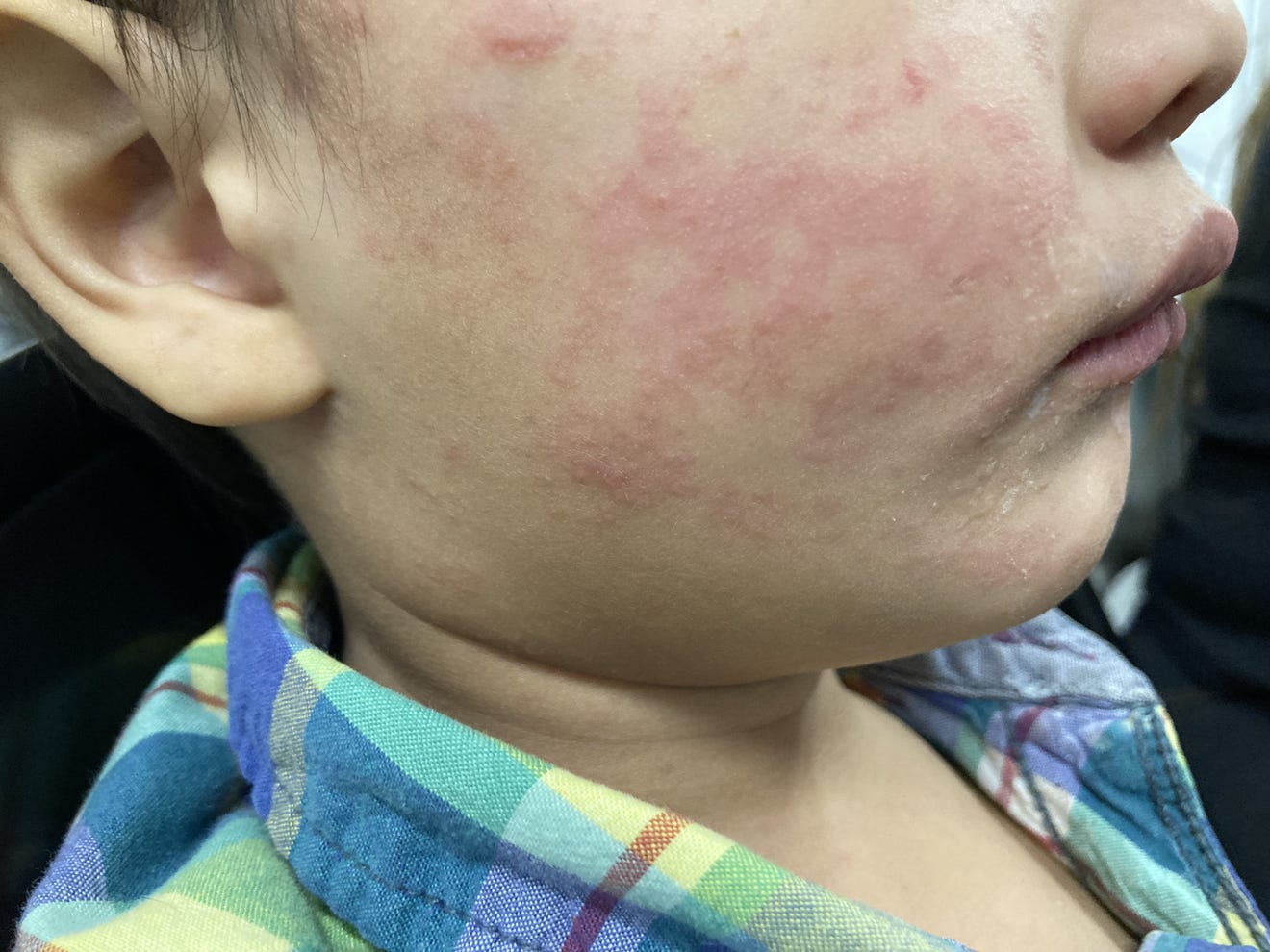 Virginia Reports Second Measles Case In 2025: Full Details Virginia Reports Second Measles Case In 2025: Full Details